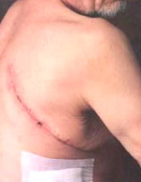 Scarring After Cancer Surgery
